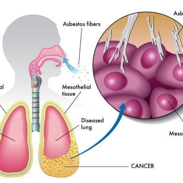 what-to-know-about-filing-a-personal-injury-lawsuit-for-mesothelioma.