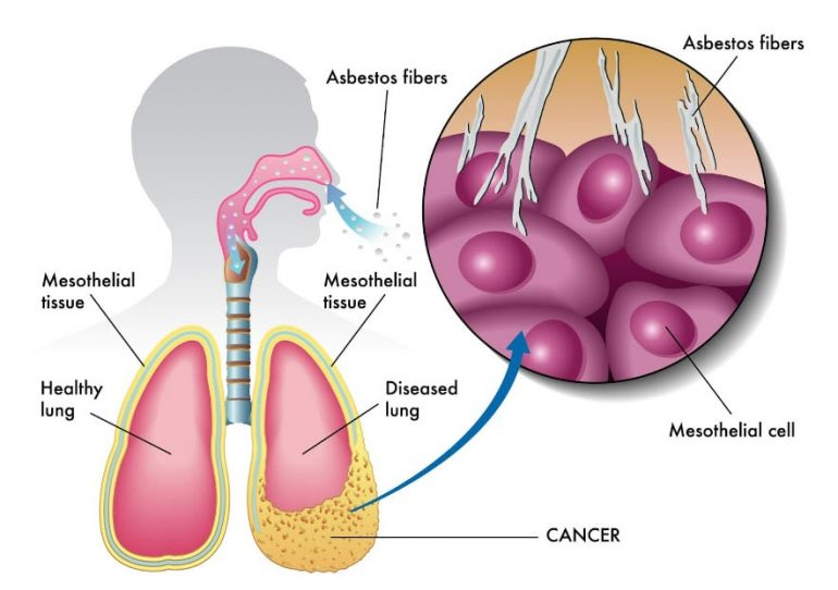 what-to-know-about-filing-a-personal-injury-lawsuit-for-mesothelioma.